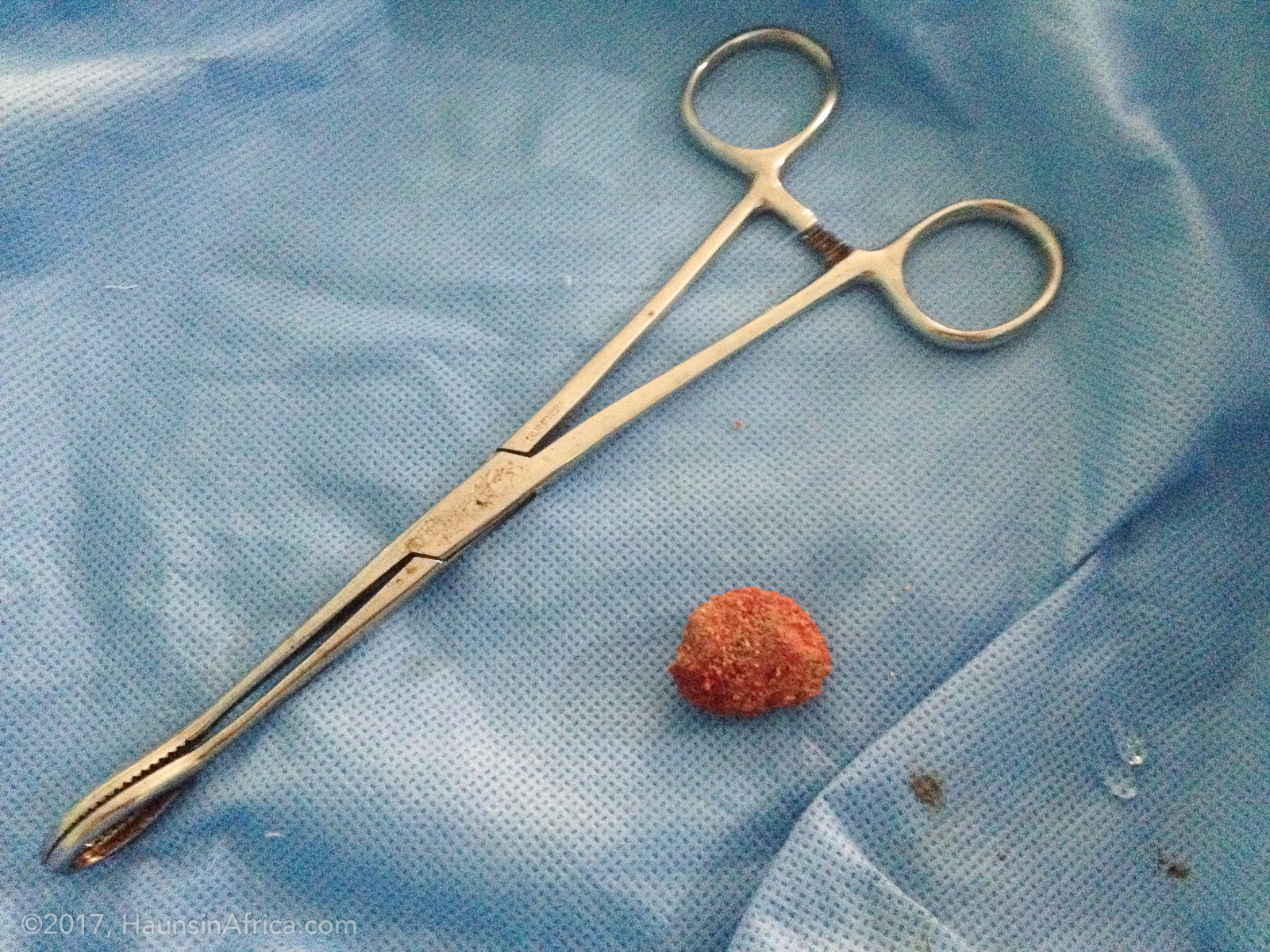 Bladder Stone - The Hauns in Africa
