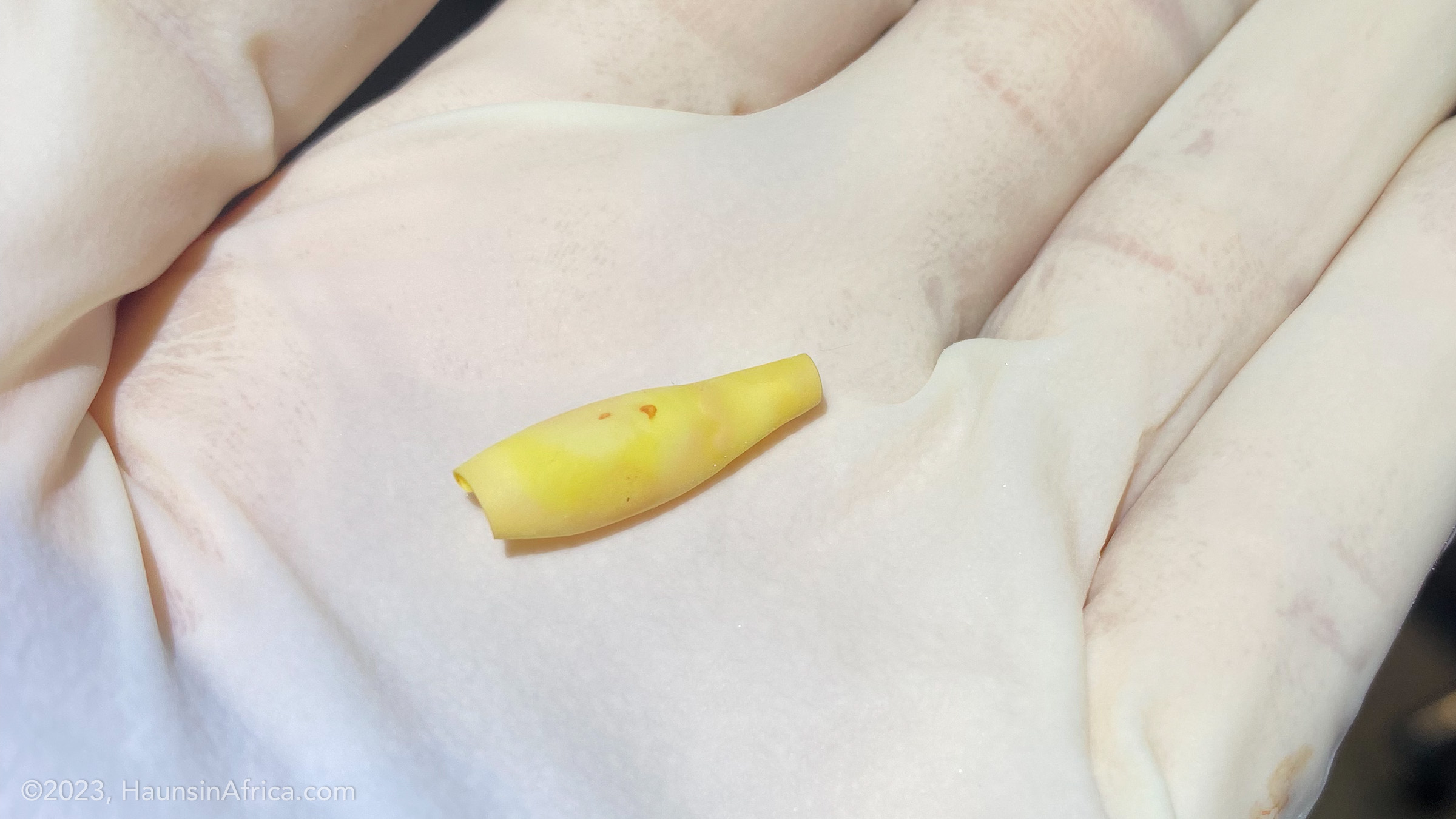 Complications From a Ruptured Foley Balloon The Hauns in Africa