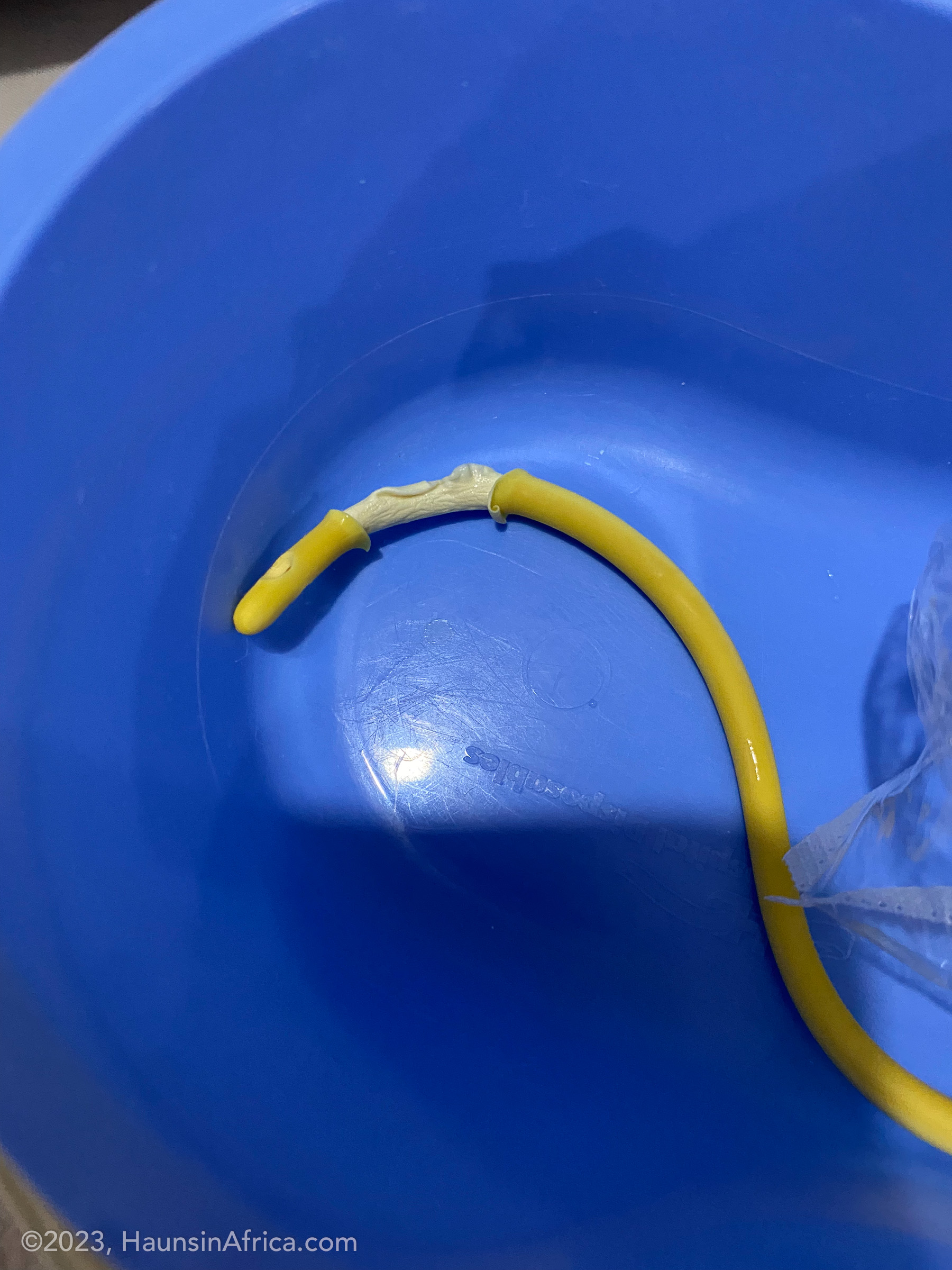 Complications From a Ruptured Foley Balloon The Hauns in Africa