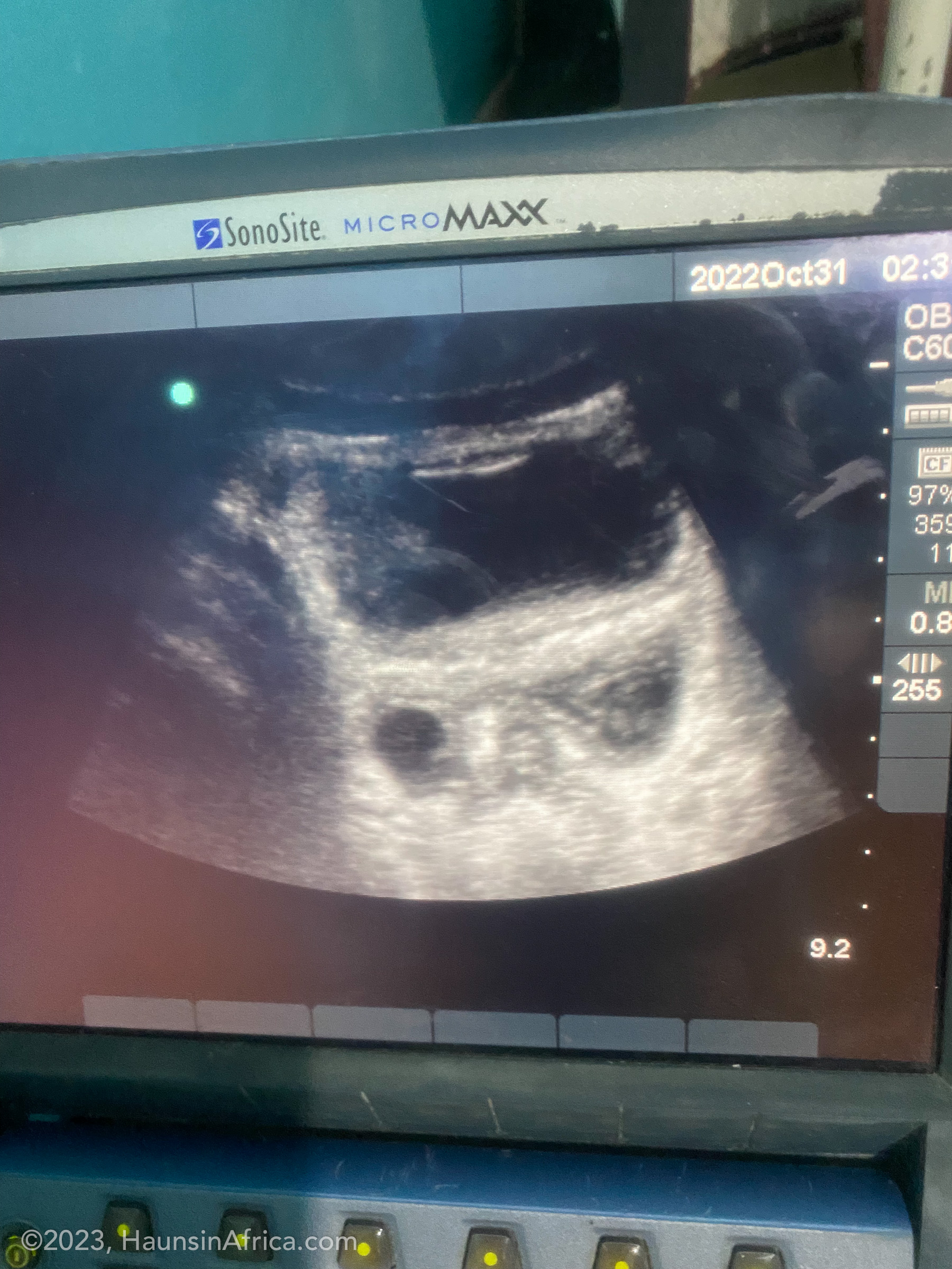 Complications From a Ruptured Foley Balloon The Hauns in Africa