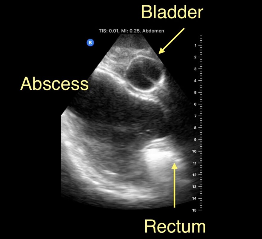 Transrectal Drainage - The Hauns in Africa