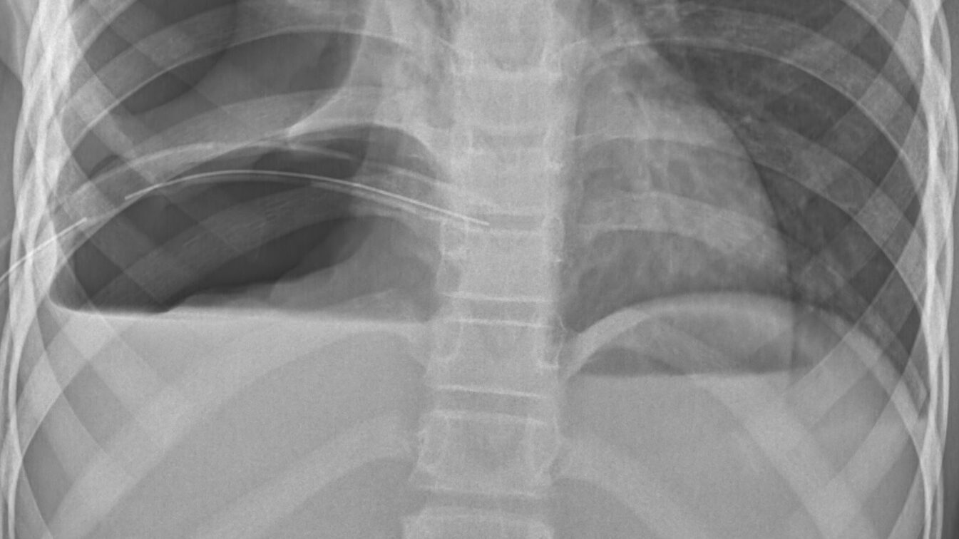Two Thoracotomies in Two Months - The Hauns in Africa