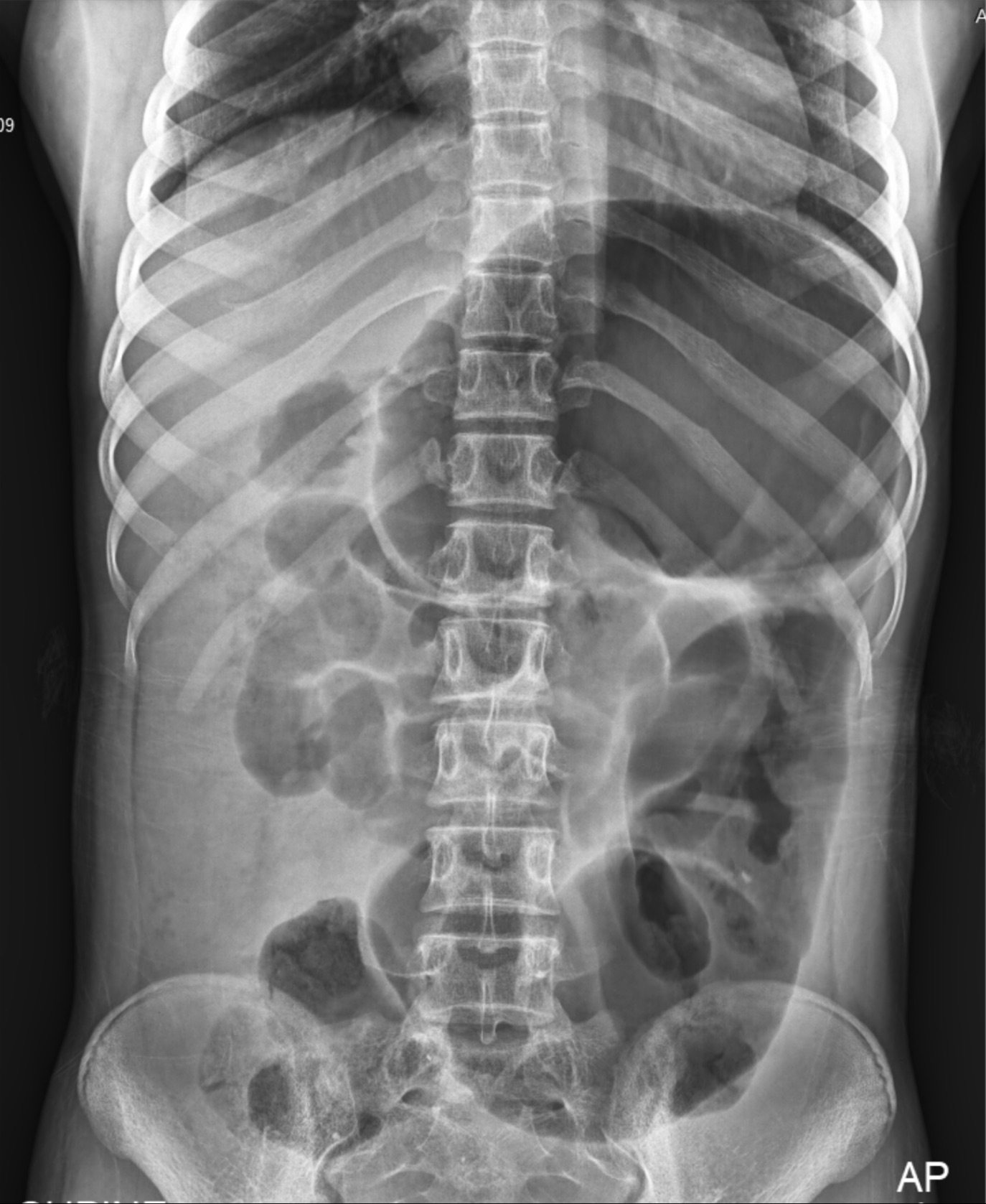 Volvulus Cec Rx Cecal Volvulus X Ray Sign